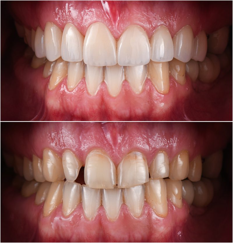 Emax lithium disilicate crown — aesthetic dental restoration Sydney